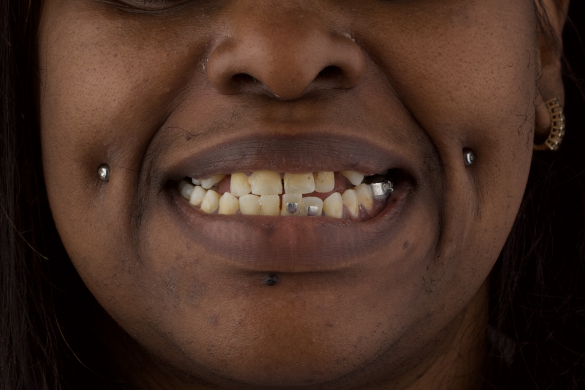 Before dental treatment Colombia patient smile