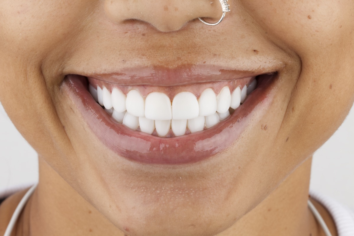 After porcelain veneers Colombia stunning smile result