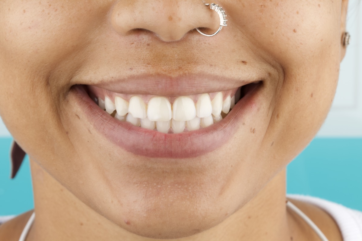 Before porcelain veneers Colombia patient