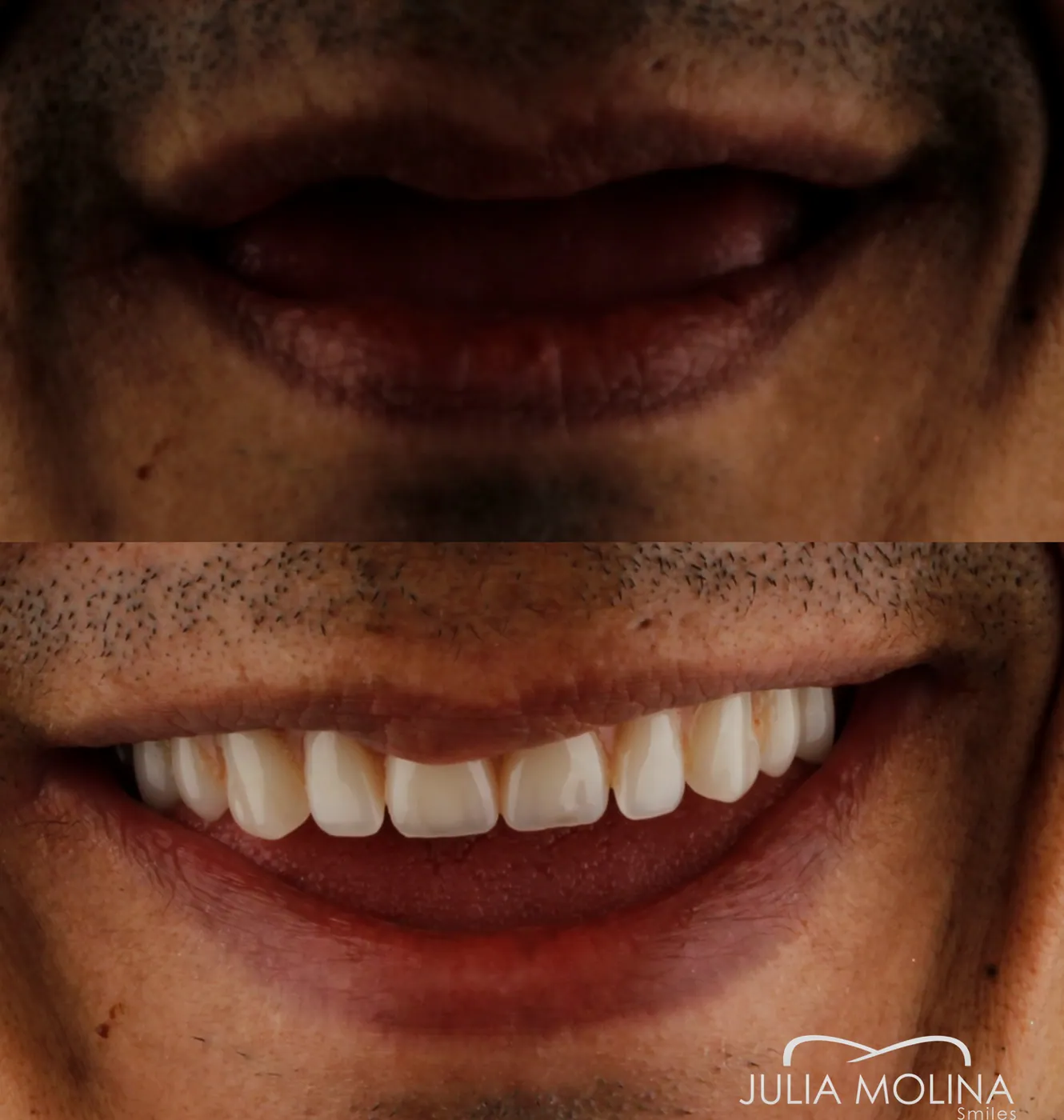 Smile restored with dental implants in Cali, Colombia