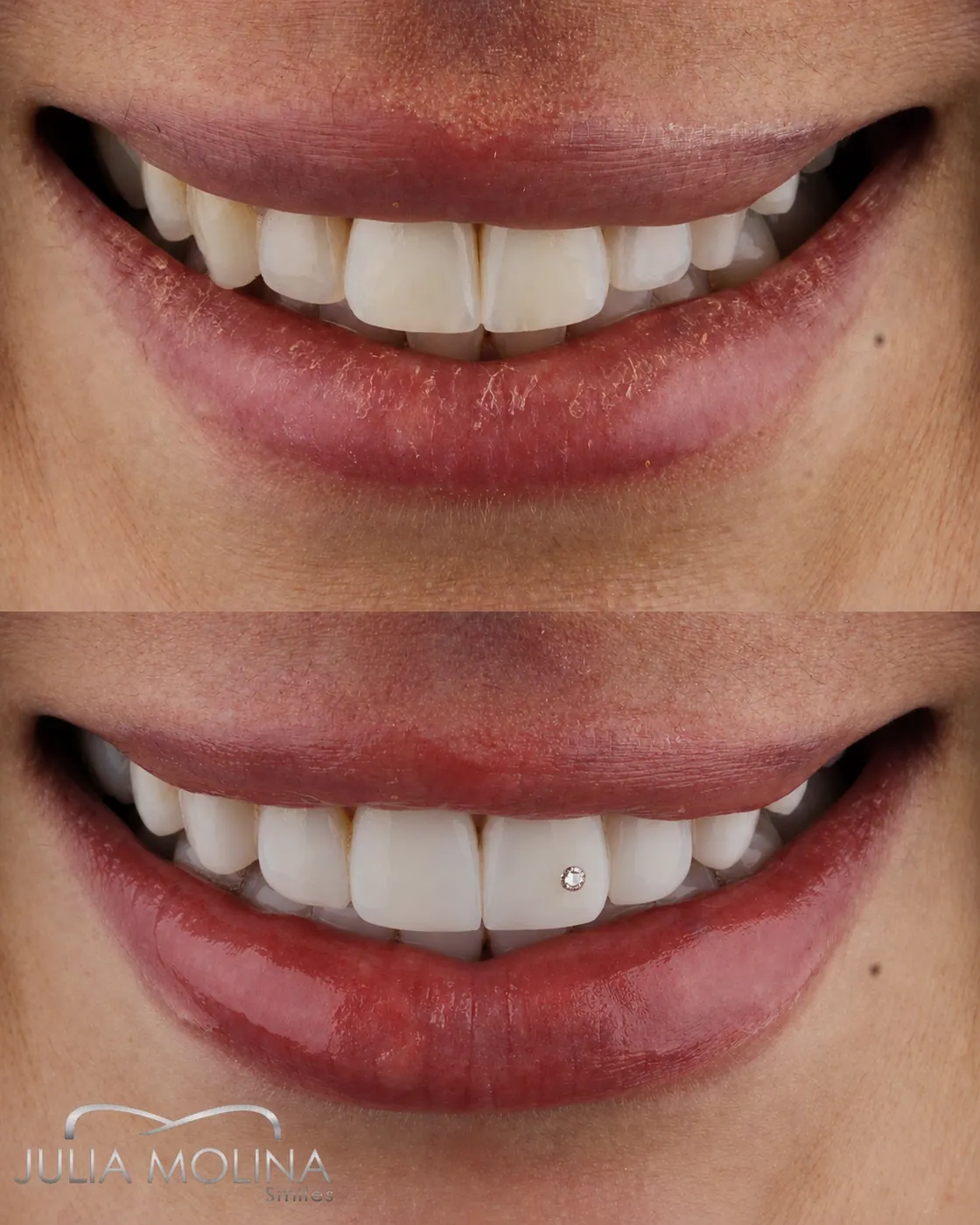 Dental jewelry before and after: diamond on the tooth surface, Smiles by Julia Molina