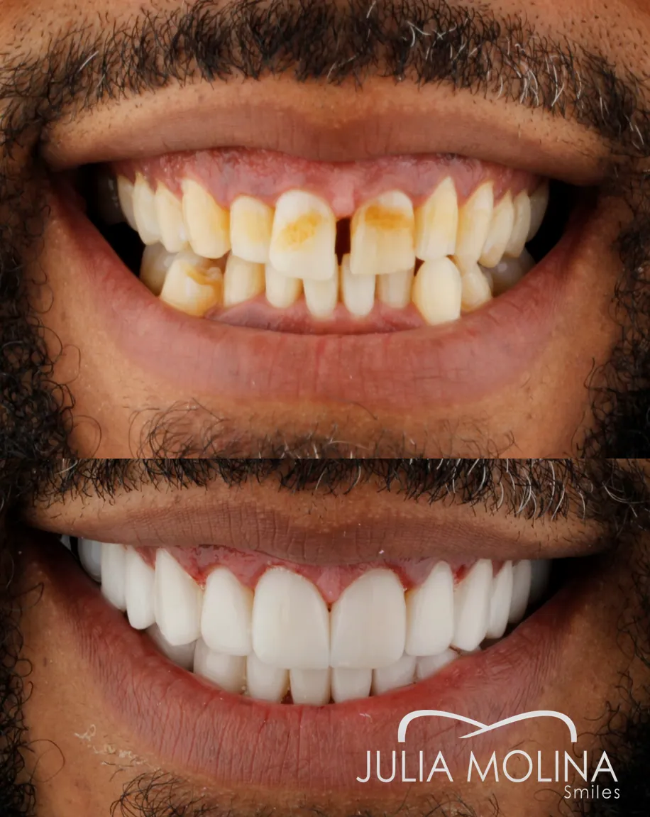 Natural-looking veneers result in Colombia