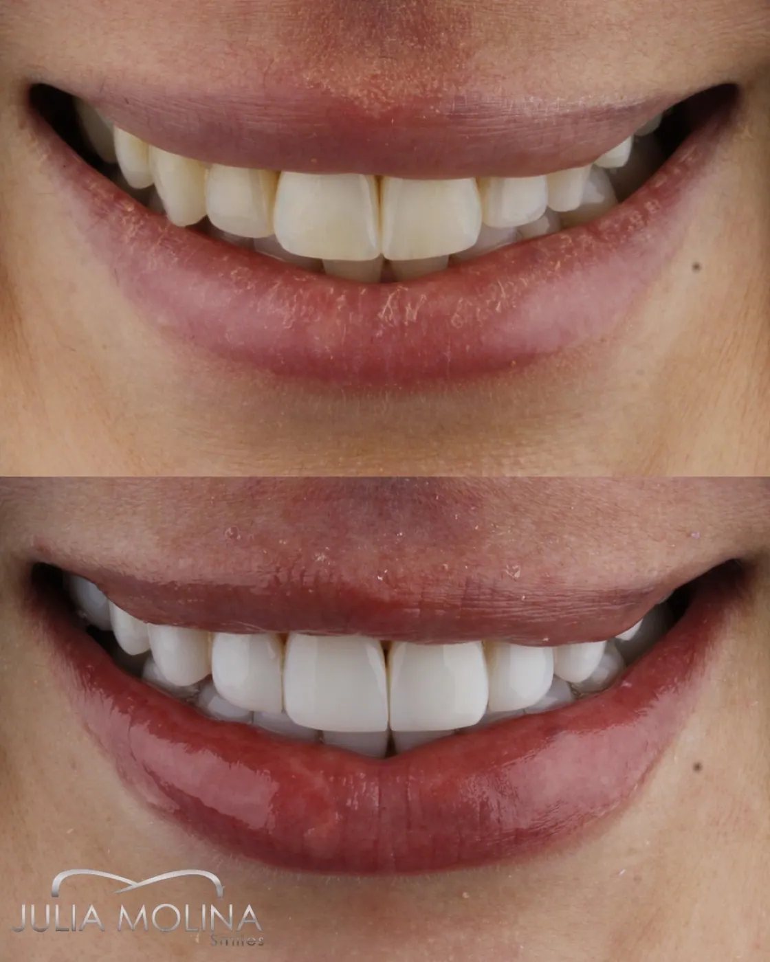 Porcelain veneers before and after, Smiles by Julia Molina Colombia
