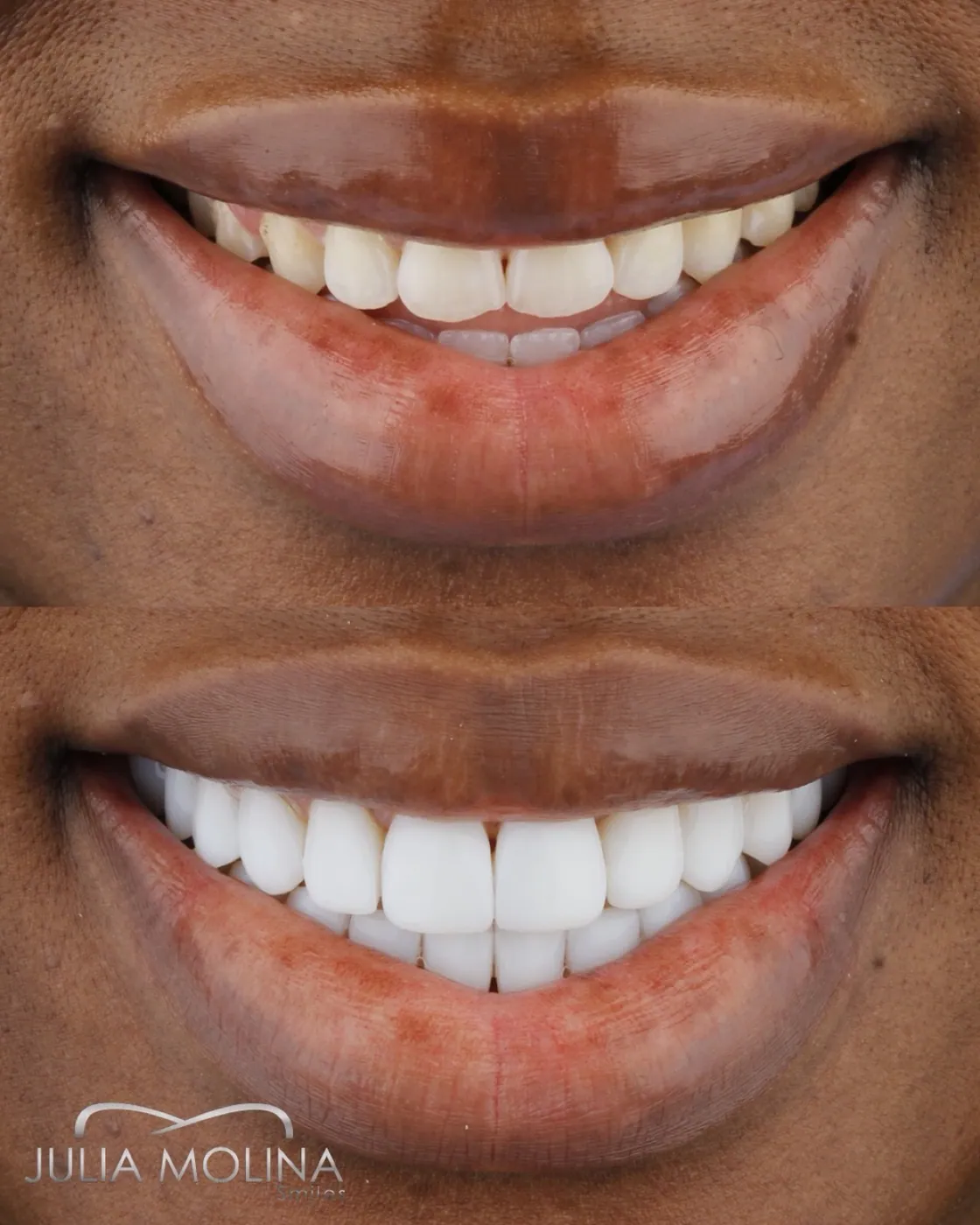Smile design before and after in Colombia