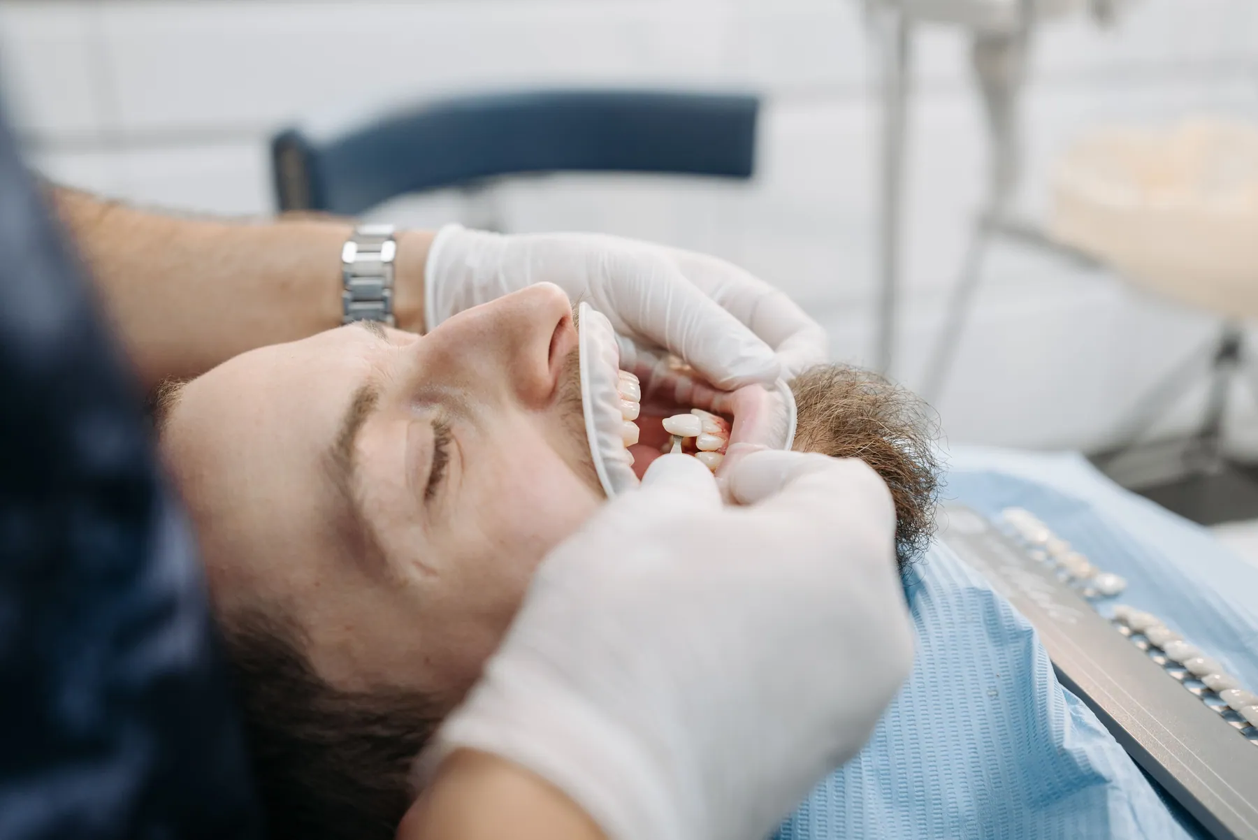 Zirconia bridge placement in Colombia, Smiles by Julia Molina